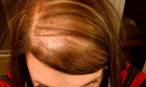 female-hair-loss